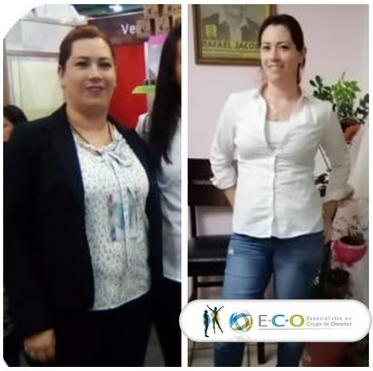 lo que no te dicen de las cirugias bariatricas baratas